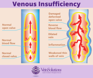 Venous insufficiency often causes varicose veins