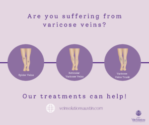 treatments for varicosities