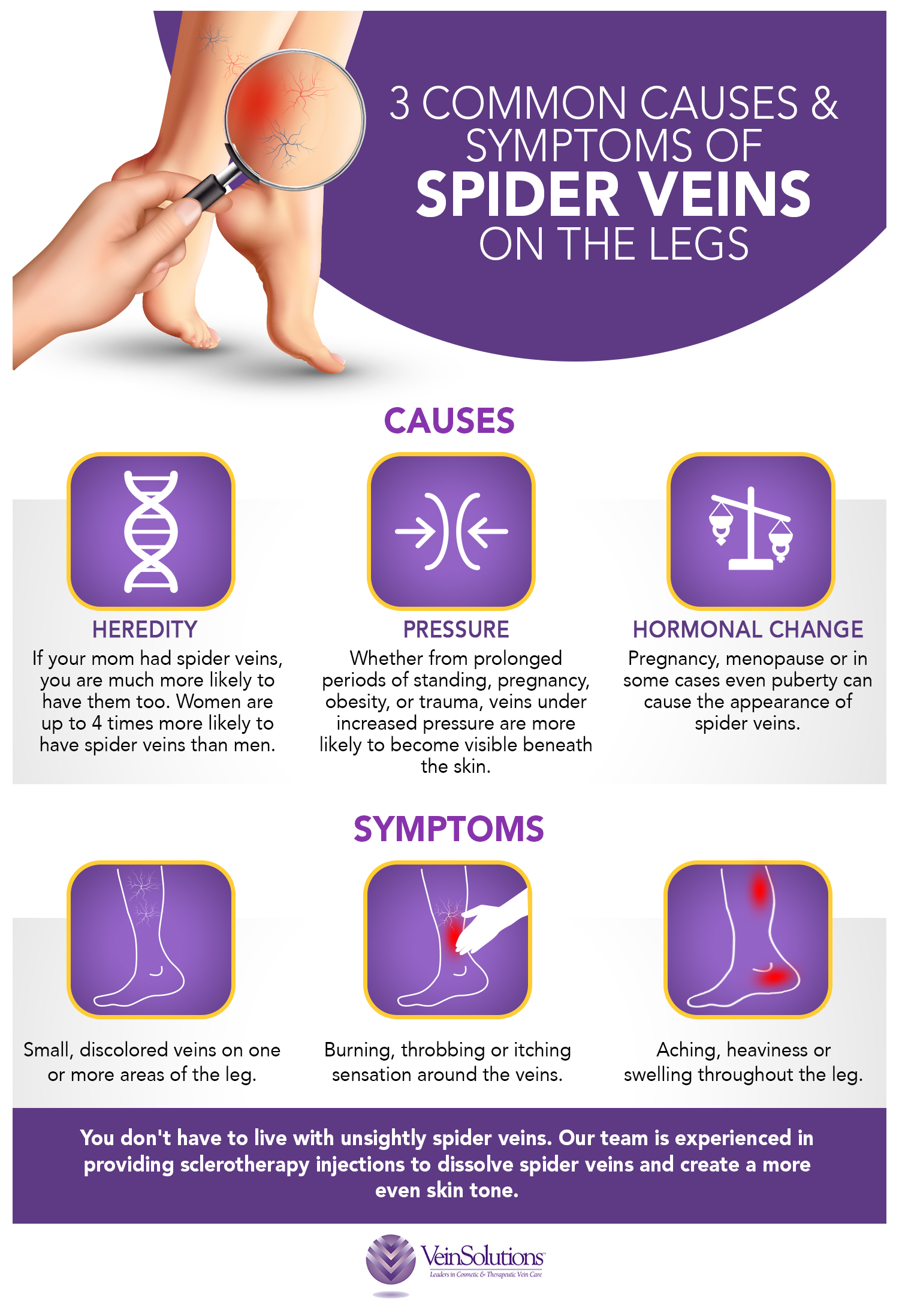 What age is normal for varicose veins?