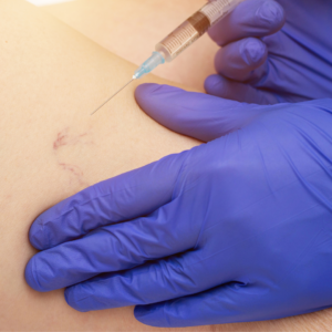 sclerotherapy
